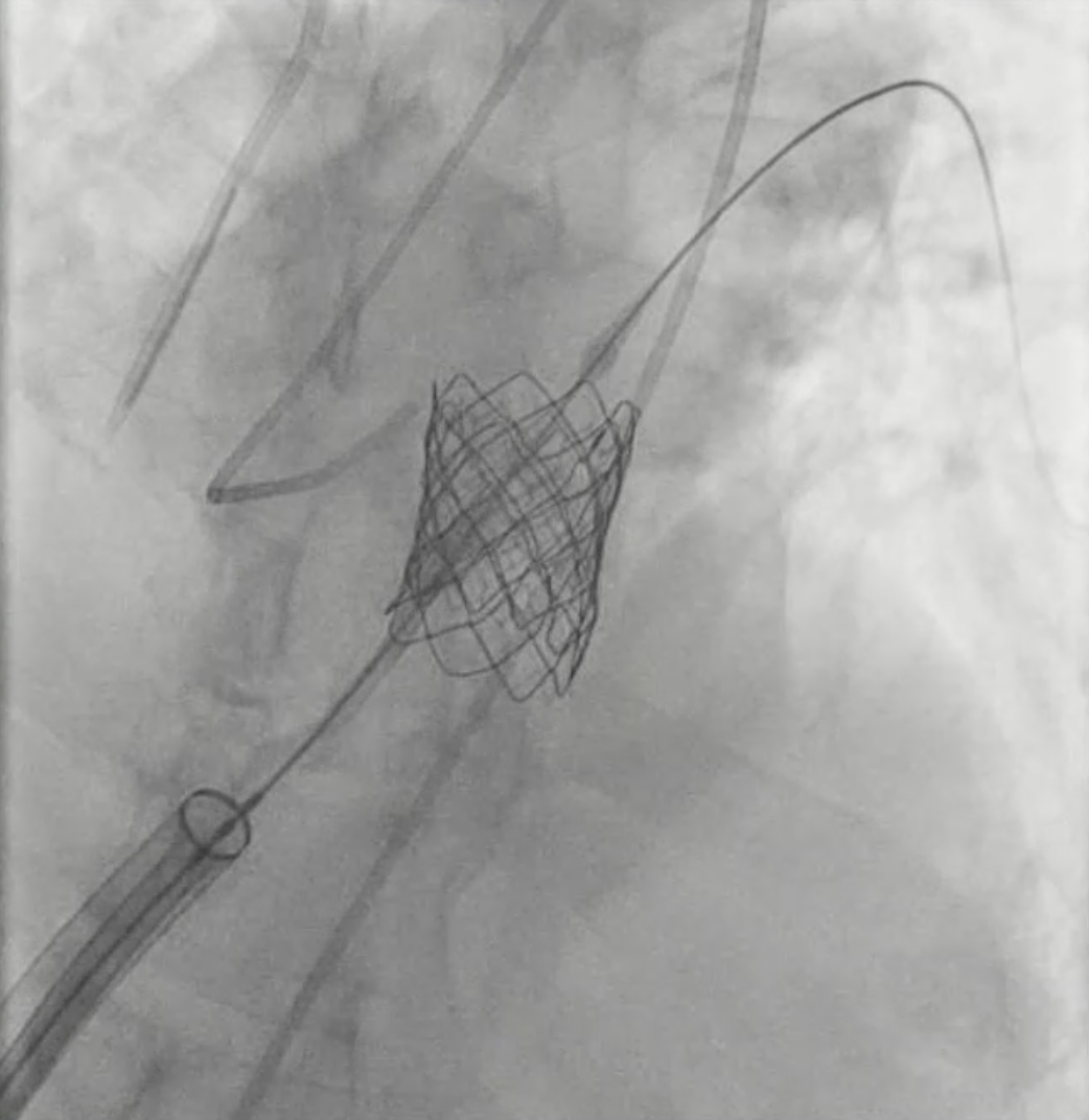 (Case 2) Figure 5. Post procedure angiogram.