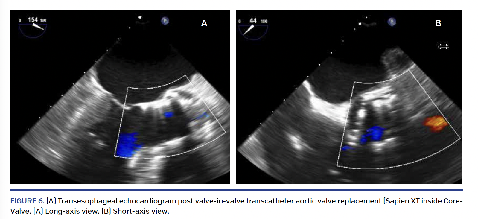 FIGURE 6. (A) Transesophageal echocardiogram post valve-in-valve transcatheter aortic valve replacement (Sapien XT inside Core- Valve. (A) Long-axis view. (B) Short-axis view.