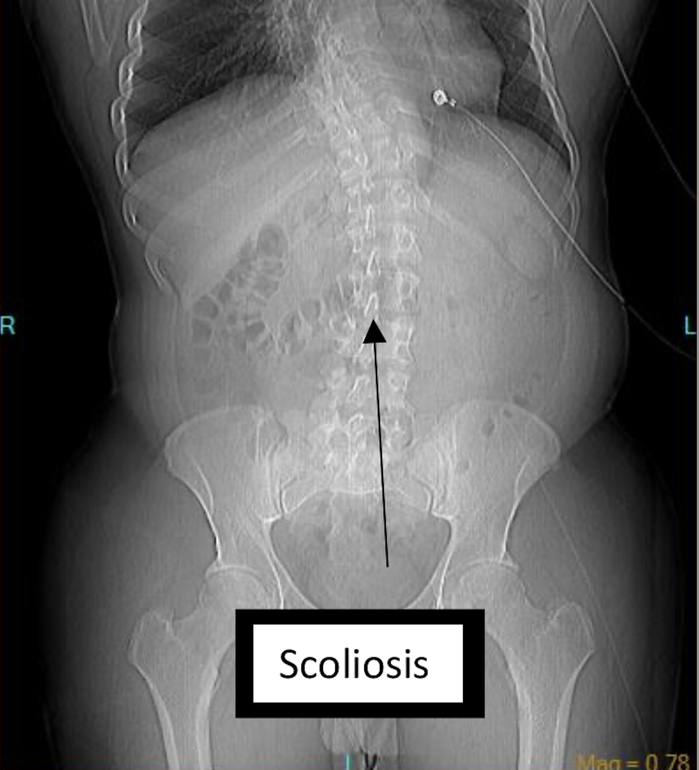 Figure 5. Scoliosis