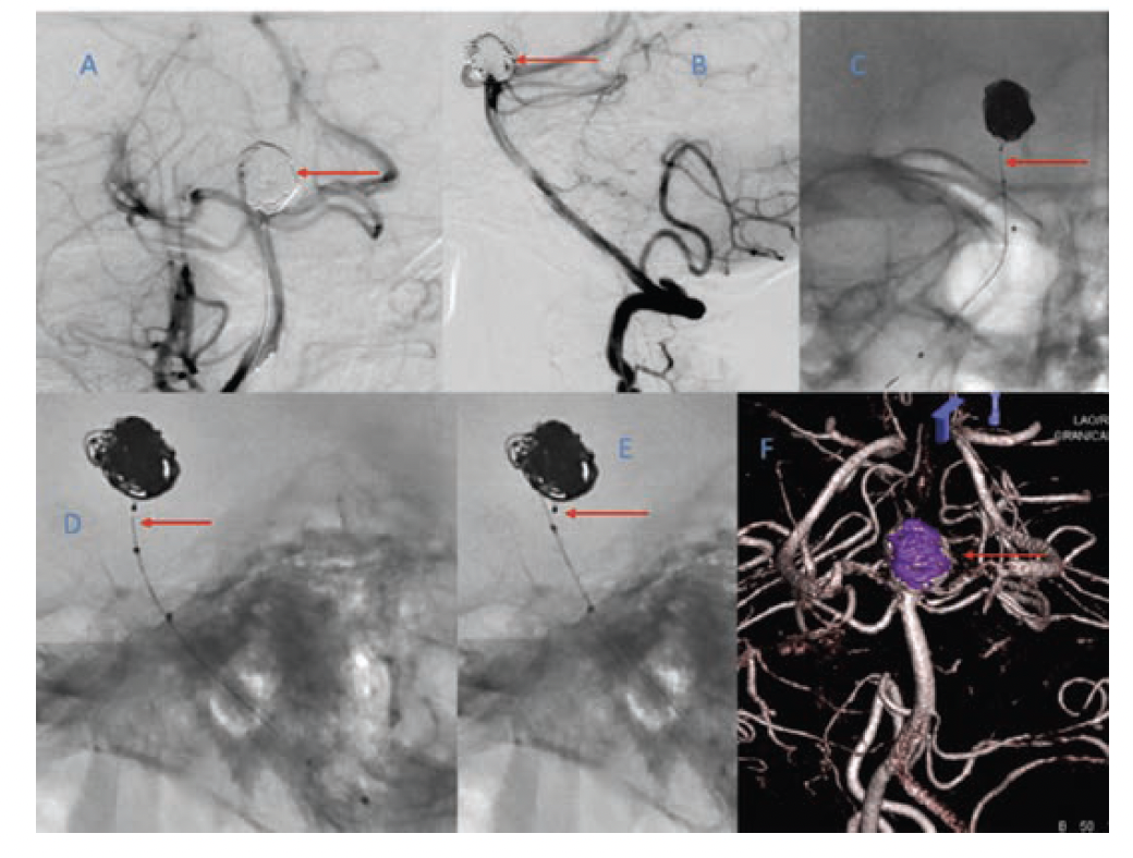 Figure 5. (A) and (B) Complete coiling of the aneurysm sac. (C) and (D) Neqstent still not deployed with the delivery wire in line with the implant radiopaque marker. (E) Neqstent deployed using electrolytic detachment system (arrow) showing the discontinuity between the delivery wire and implant radiopaque marker. (F) 3D reconstructed image showing normal opacification of bilateral posterior cerebral artery and superior cerebellar arteries and non-opacification of the aneurysm.