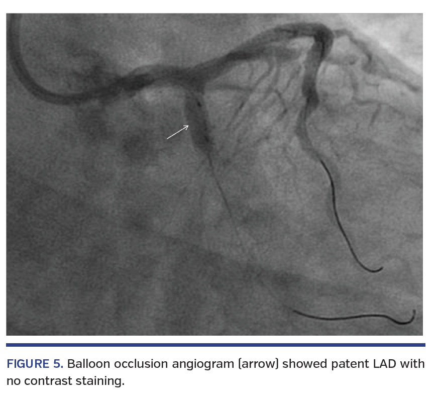 FIGURE 5. Balloon occlusion angiogram (arrow) showed patent LAD with no contrast staining.