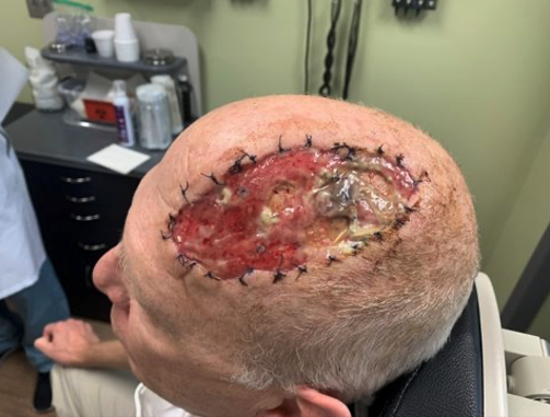 Post-op visit day 23