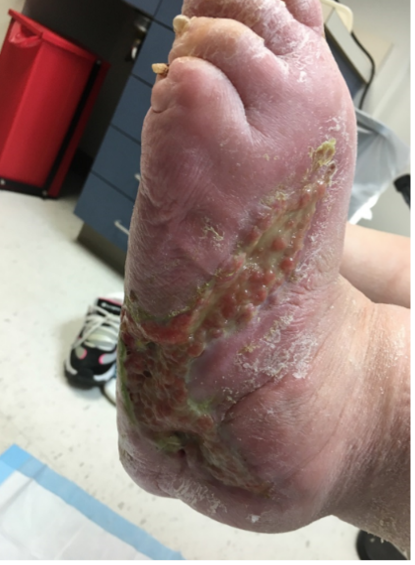 6 weeks after stravix tissue