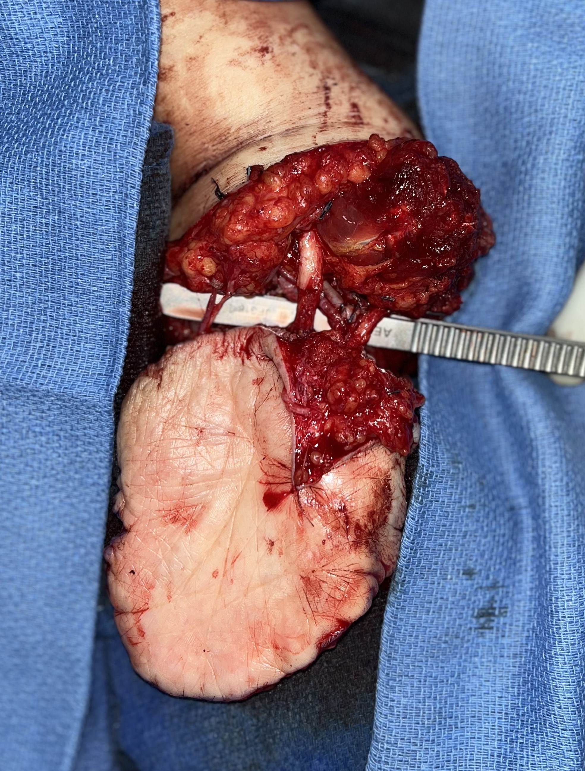 Figure 5: The ulnar artery pedicle of the flap is anastomosed to the radial artery proximally, demonstrating excellent perfusion. The proximal median and ulnar nerves are coapted to their respective distal targets in the flap.