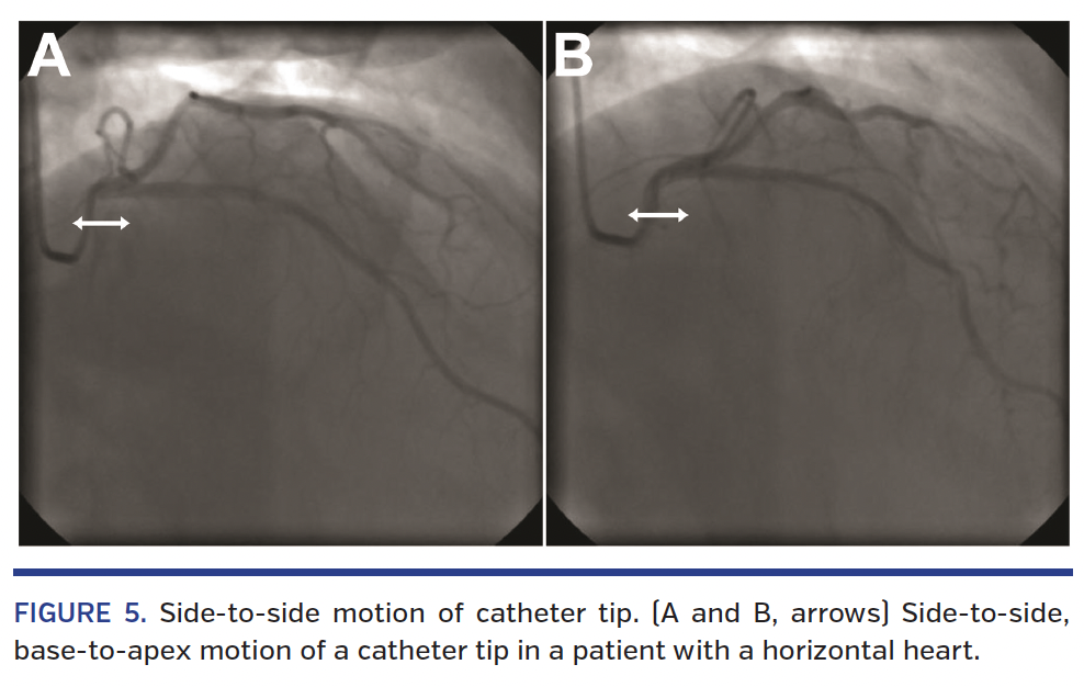 FIGURE 5. Side-to-side motion of catheter tip. (A and B, arrows) Side-to-side, base-to-apex motion of a catheter tip in a patient with a horizontal heart.