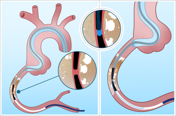 Figure 6. Illustration of the rendezvous technique