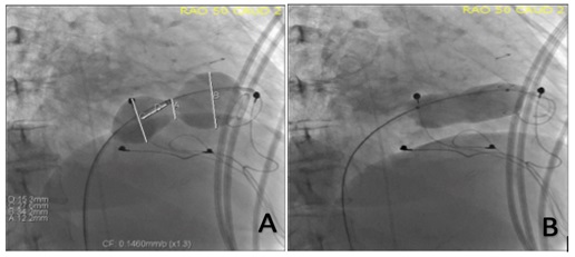 Figure 6. Balloon sizing at baseline and post-dilation (case 2).