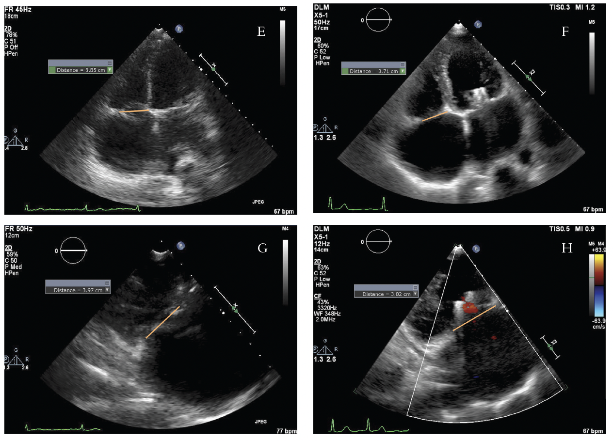 FIGURE 6. Final result by echocardiography..png