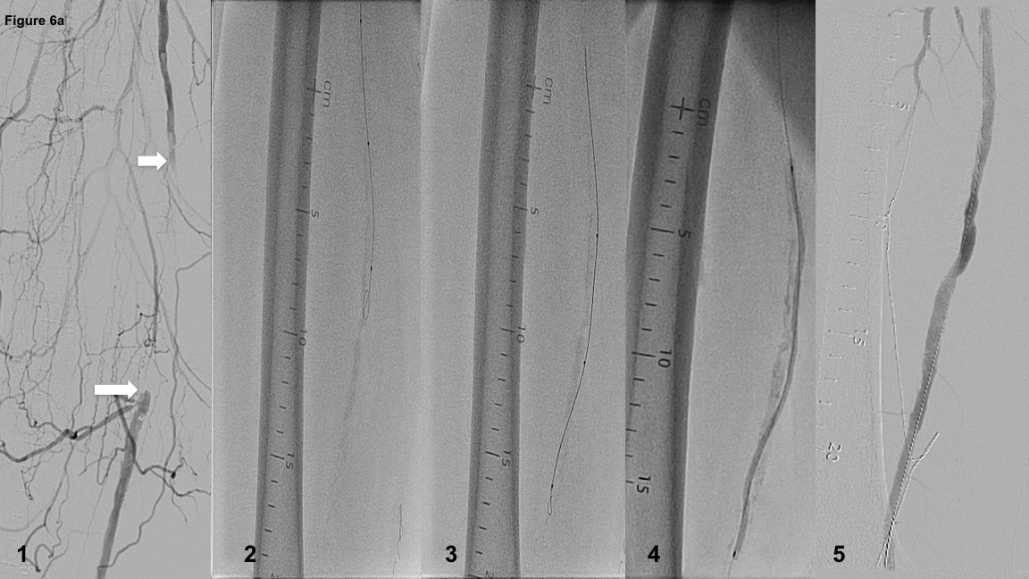 FIGURE 6. (A) Case example of antegrade dissection re-entry of femoropopliteal chronic total occlusion (CTO) with .035˝ GlideWire and support catheter and limited antegrade subintimal tracking and guidewire re-entry into the distal vessel true lumen. Arrowheads indicate proximal and distal superficial femoral artery CTO caps, respectively. (B) Depiction of the crossing strategy on the PCTO algorithm.