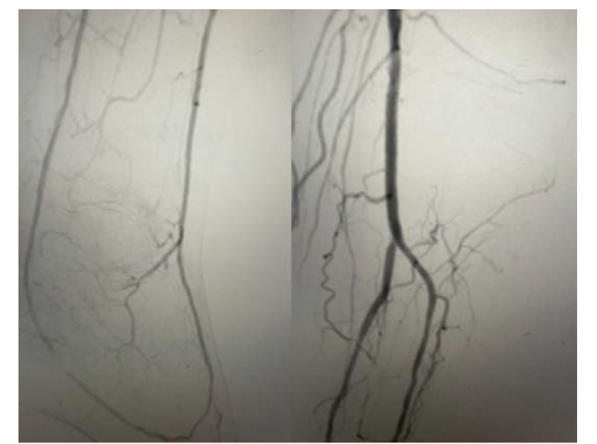 Figure 6. Final angiographic views revealing patent anterior and posterior tibial arteries, and successful retrograde intervention with complete reconstitution of the pedal arch.