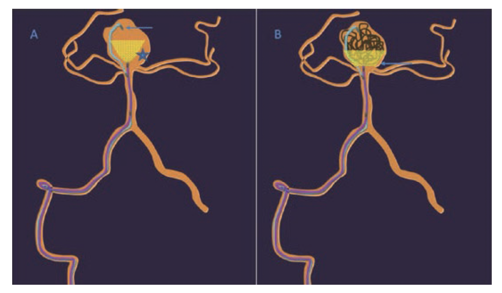 Figure 6. (A) Line diagram showing coiling microcatheter (arrow) well within the aneurysm sac jailed by the side of the Neqstent (star), which is just above the aneurysm neck. (B) After partial coiling, slight manipulation of the Neqstent with gentle pull and push makes it sit well across the aneurysm neck before detaching it (arrow).