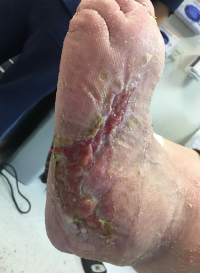 8 weeks after stravix tissue