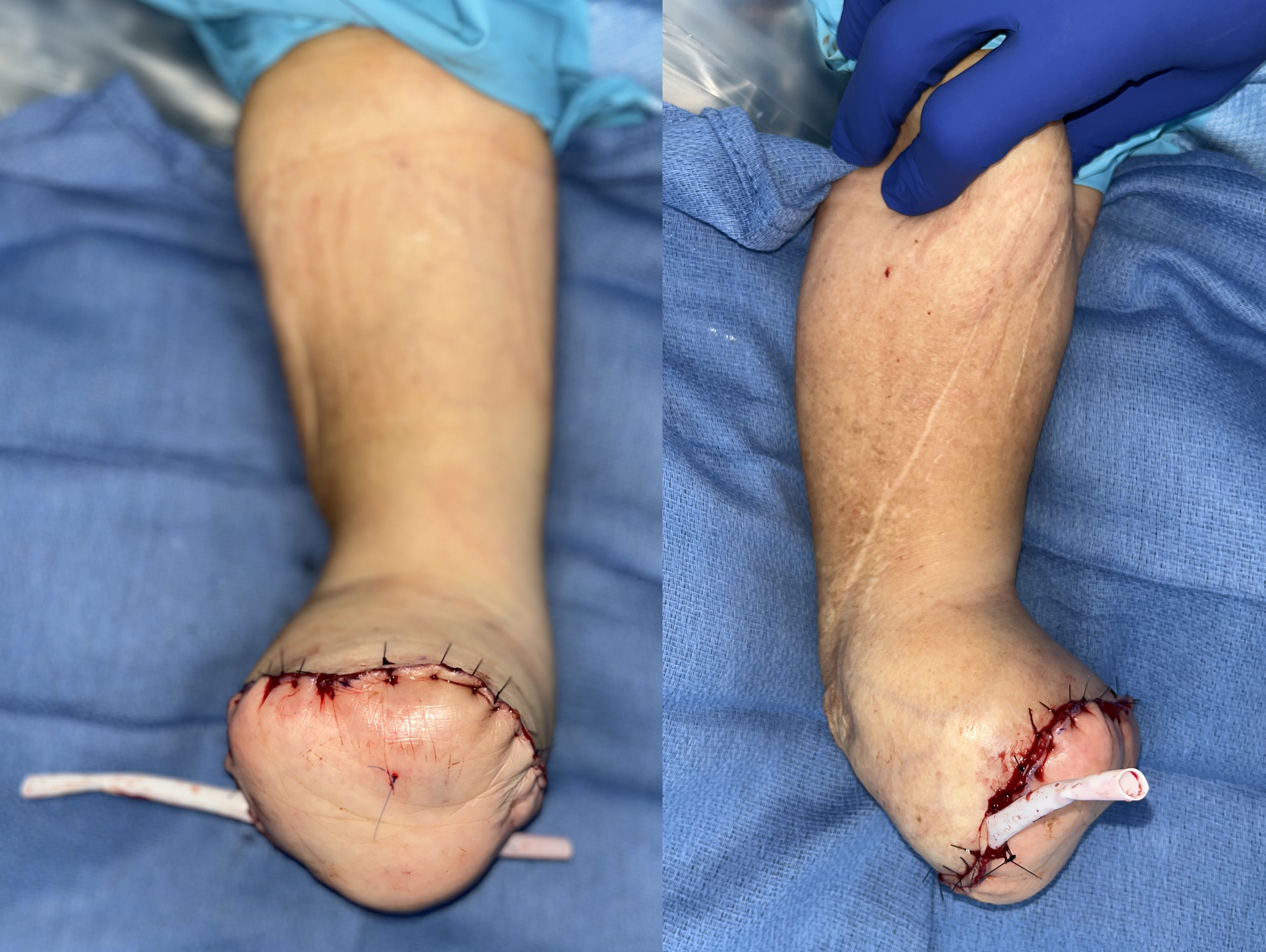 Figure 6: Closure and inset of the flap over a Penrose drain.