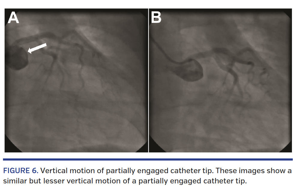 FIGURE 6. Vertical motion of partially engaged catheter tip. These images show a similar but lesser vertical motion of a partially engaged catheter tip.