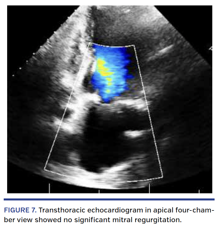 FIGURE 7. Transthoracic echocardiogram in apical four-chamber view showed no significant mitral regurgitation.
