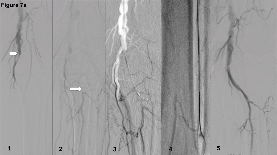 FIGURE 7. (A) Case example of failed antegrade crossing of femoropopliteal chronic total occlusion (CTO) and switch to a hybrid retrograde crossing via pedal artery access and support catheter and limited antegrade subintimal tracking and reverse CART entry into distal superficial femoral artery. Arrowheads indicate the popliteal artery proximal CTO cap and below-the-knee tibial artery distal CTO cap, respectively. (B) Depiction of the crossing strategy on the PCTO algorithm.