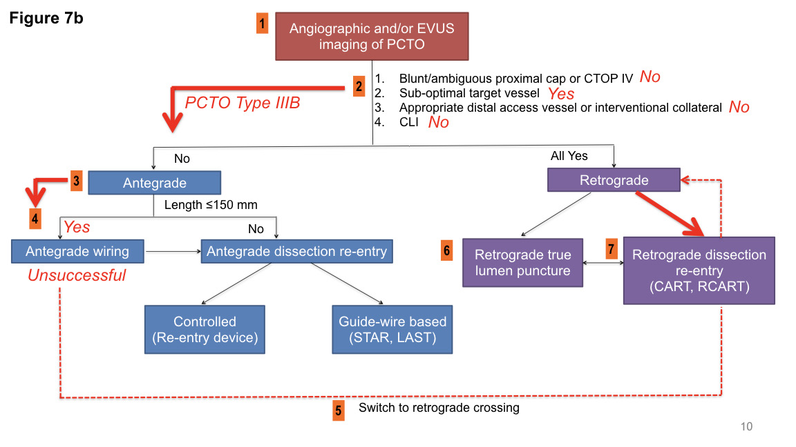 FIGURE 7. (A) Case example of failed antegrade crossing of femoropopliteal chronic total occlusion (CTO) and switch to a hybrid retrograde crossing via pedal artery access and support catheter and limited antegrade subintimal tracking and reverse CART entry into distal superficial femoral artery. Arrowheads indicate the popliteal artery proximal CTO cap and below-the-knee tibial artery distal CTO cap, respectively. (B) Depiction of the crossing strategy on the PCTO algorithm.
