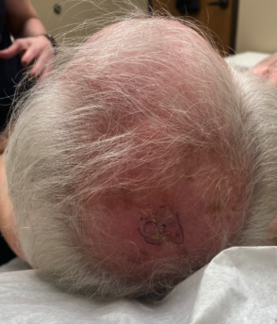 Melanoma prior to surgery