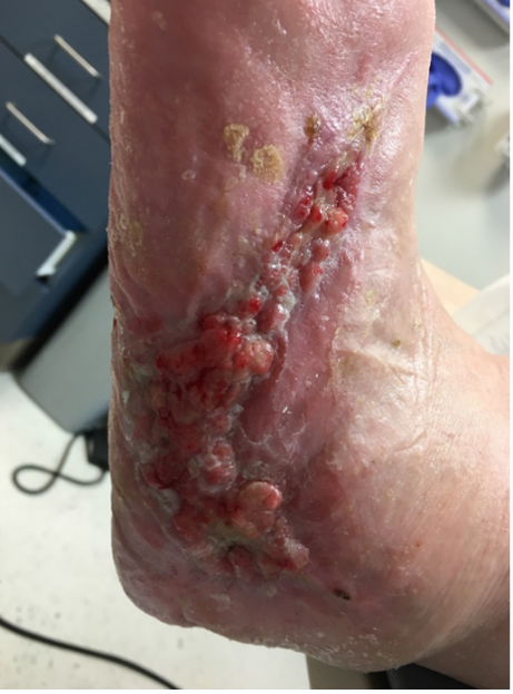 10 weeks after stravix tissue
