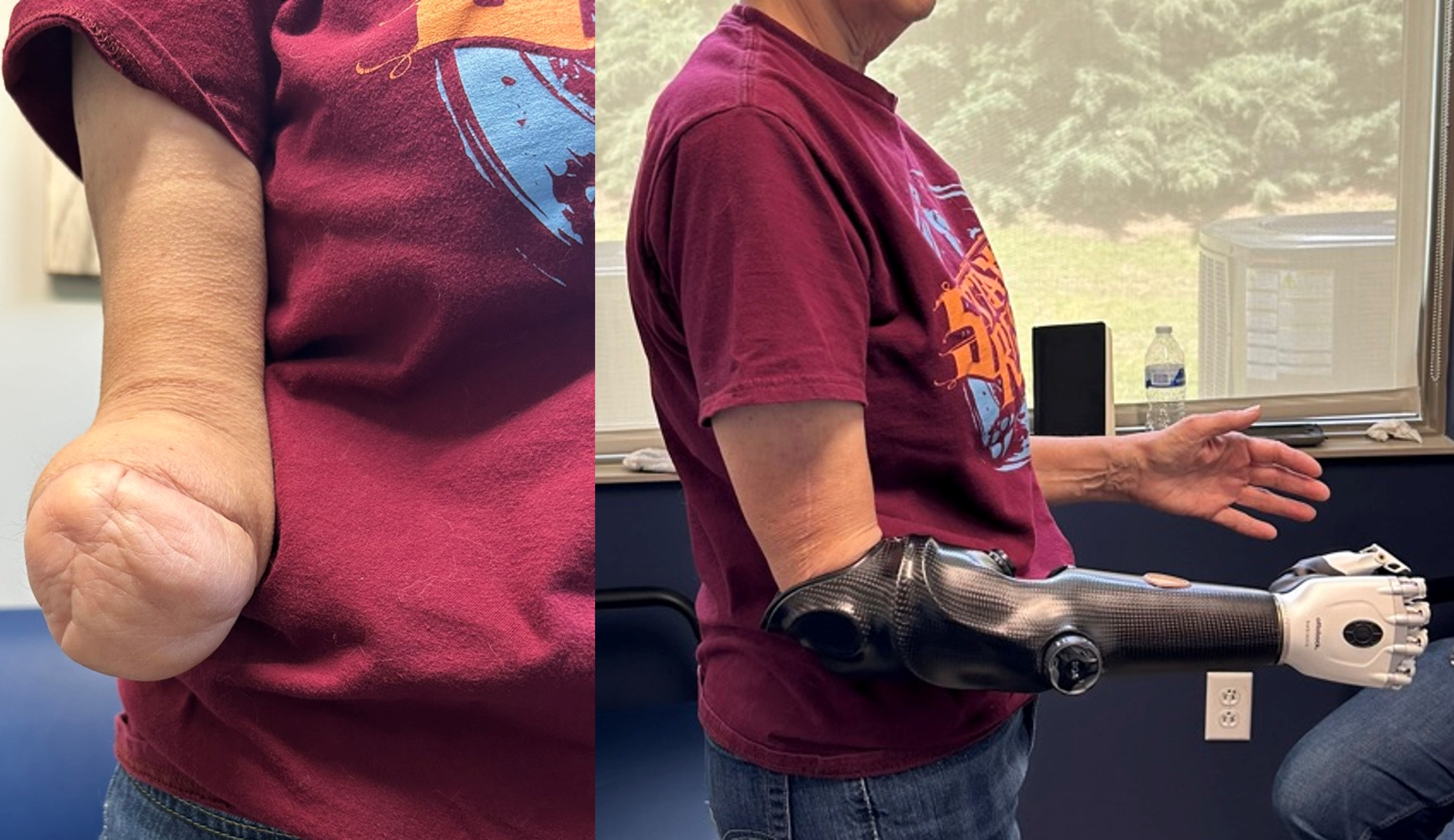 Figure 7: At 3 months postoperative, the patient demonstrated a well-healed and padded amputation stump fitted with a myoelectric prosthesis.