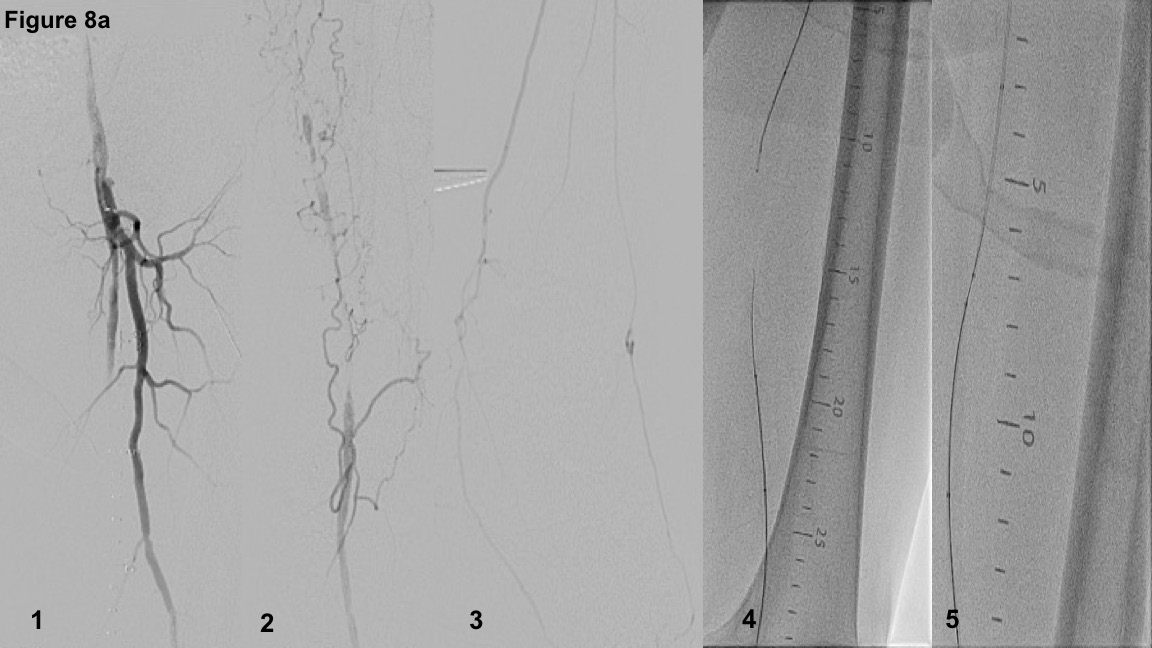 FIGURE 8. (A) Case example of a second attempt failed antegrade long femoropopliteal chronic total occlusion (CTO). Switch to a hybrid approach and “rendezvous” technique retrograde crossing into the antegrade support catheter that was retrieved to the mid superficial femoral artery to establish a more proximal base of operations. (B) Depiction of the crossing strategy on the PCTO algorithm.