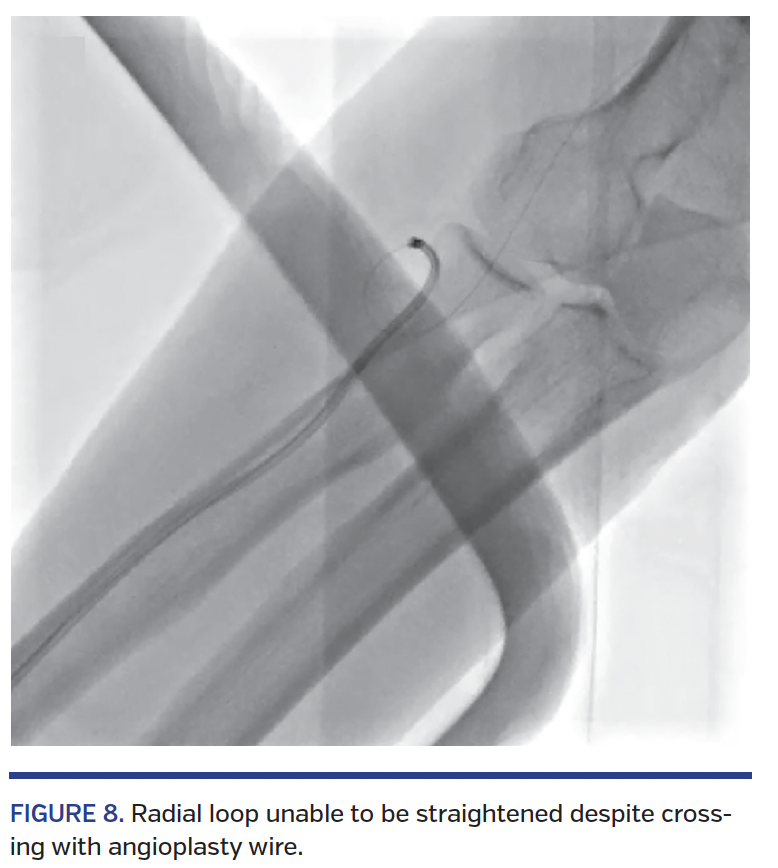 FIGURE 8. Radial loop unable to be straightened despite crossing with angioplasty wire.