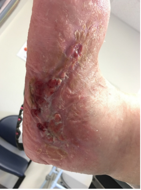 10 weeks after stravix tissue
