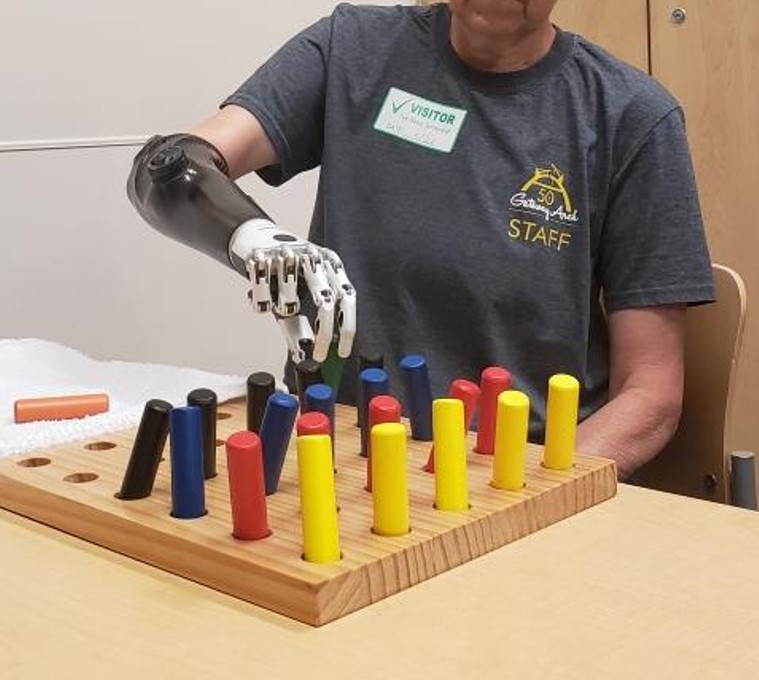 Figure 8: Patient demonstrating use of her myoelectric prosthesis.