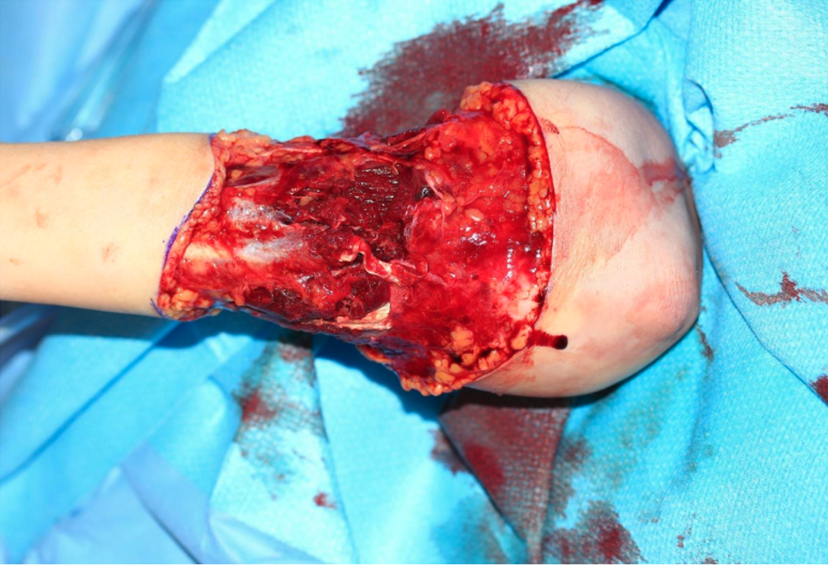 Post debridement and prior to repair of muscle and tendons