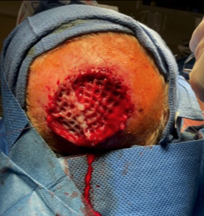Placement of stravix meshed tissue on scalp
