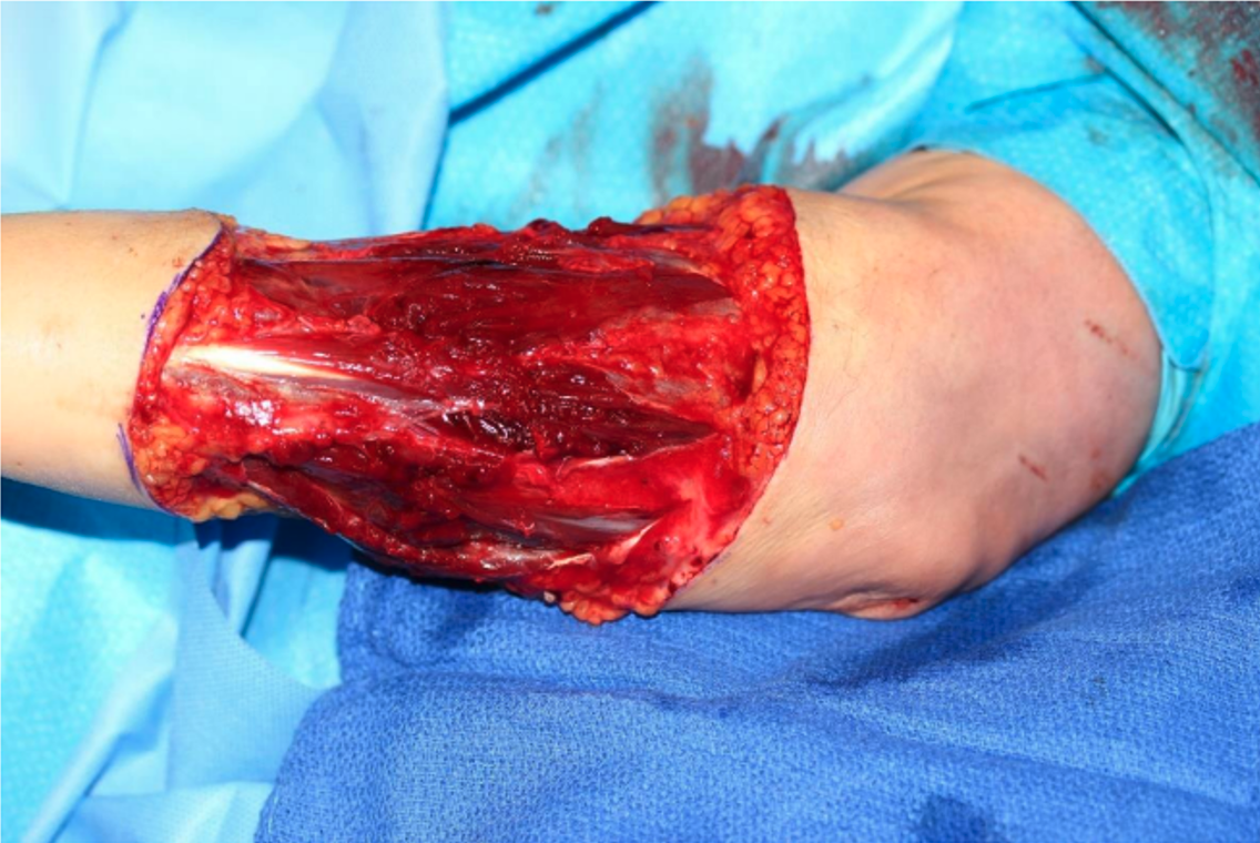 After repair of all muscles and tendons and prior to application of OASIS ULTRA Matrix