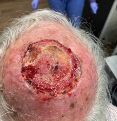First post-op visit, day 13