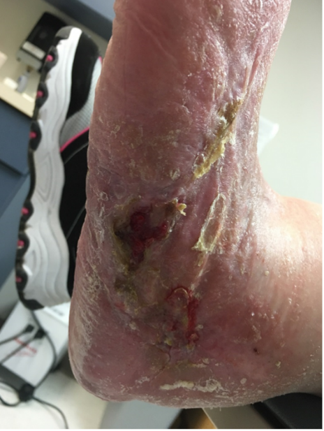 14 weeks after stravix tissue