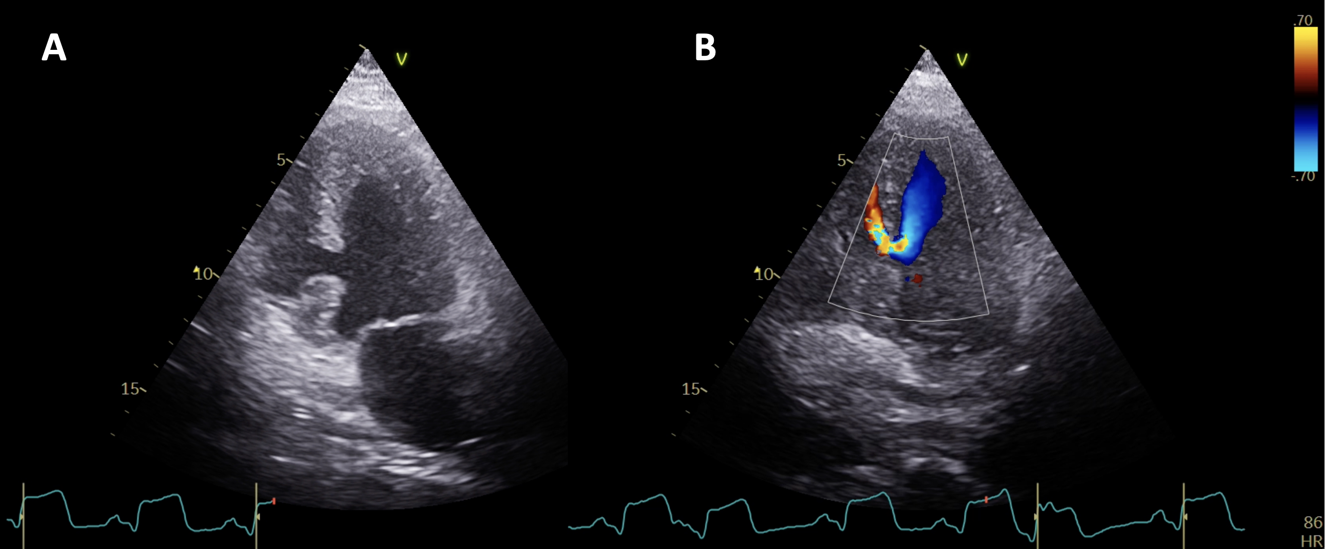 Figure. (A) Transthoracic echocardiogram