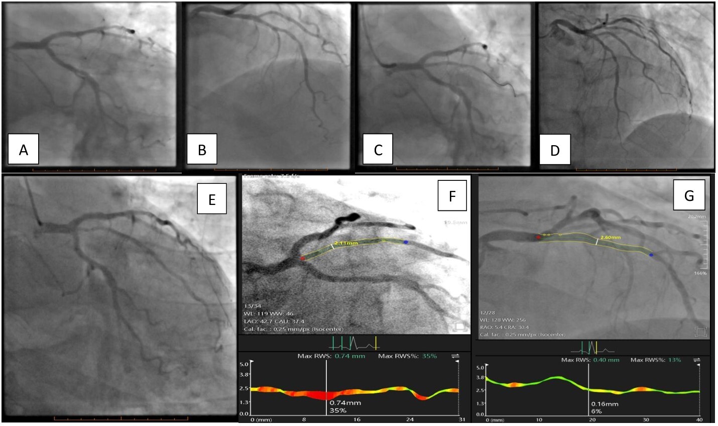 Figure. (A) Angiography 