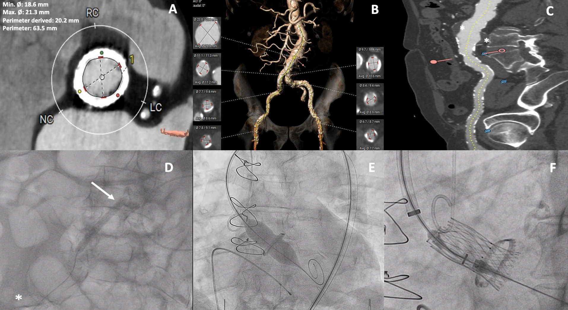Figure.  Comprehensive imaging in valve-in-valve intervention. 