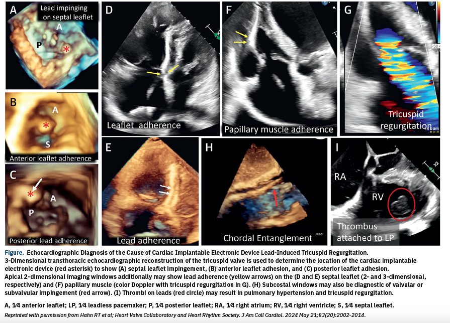 Figure. Echocardiographic Diagnosis of the Cause of Cardiac Implantable Electronic Device Lead-Induced Tricuspid Regurgitation. 
