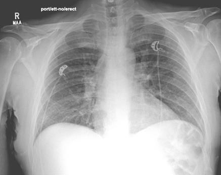 Here one can see an AP chest X-ray at admission.