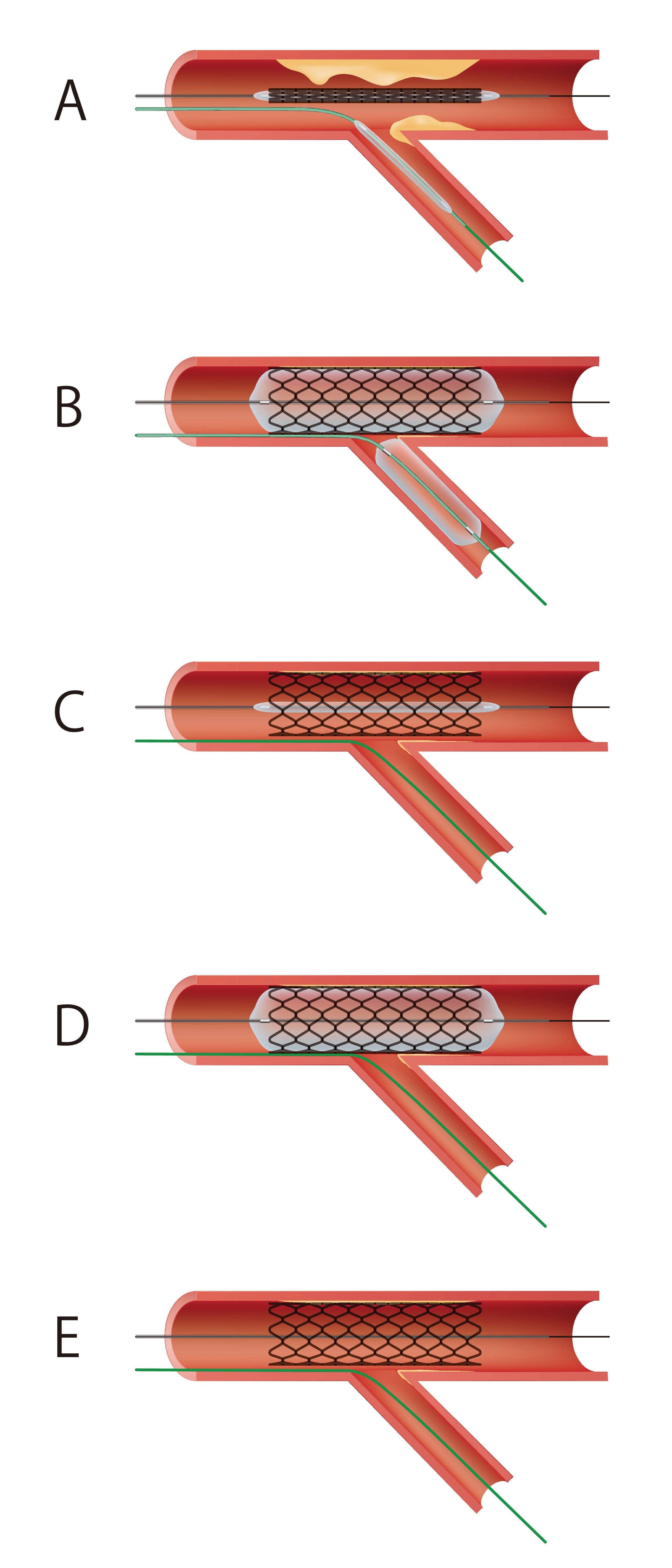 Figure 1.The proximal marker of the side branch (SB) balloon