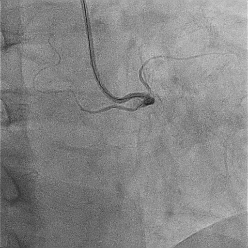 Figure 1B. Right coronary artery chronic total occlusion