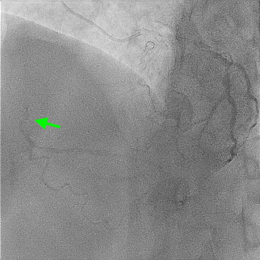 Figure 1C. Right coronary artery chronic total occlusio