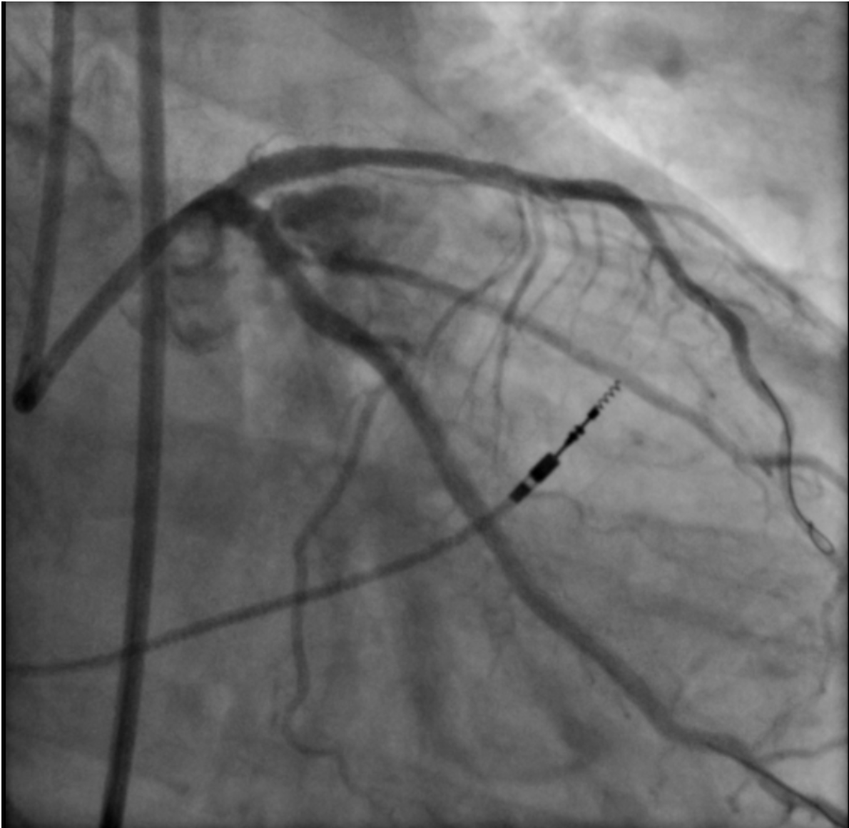 Figure 2. Perforation of the left circumflex artery after stenting 