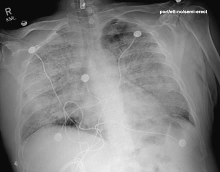 This AP X-ray of the chest is from day 4 of hospitalization.