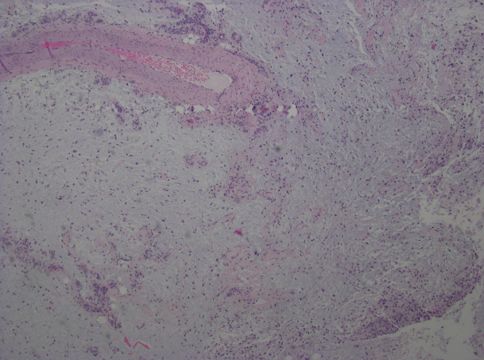Figure 2. Low power view demonstrating atypical pleomorphic cells with variably large nucleoli in a myxohyaline background and variably prominent inflammatory infiltrate.