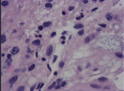 Figure 3. 100x view: High power view demonstrating atypical pleomorphic cells mixed with acute and chronic inflammatory cells.