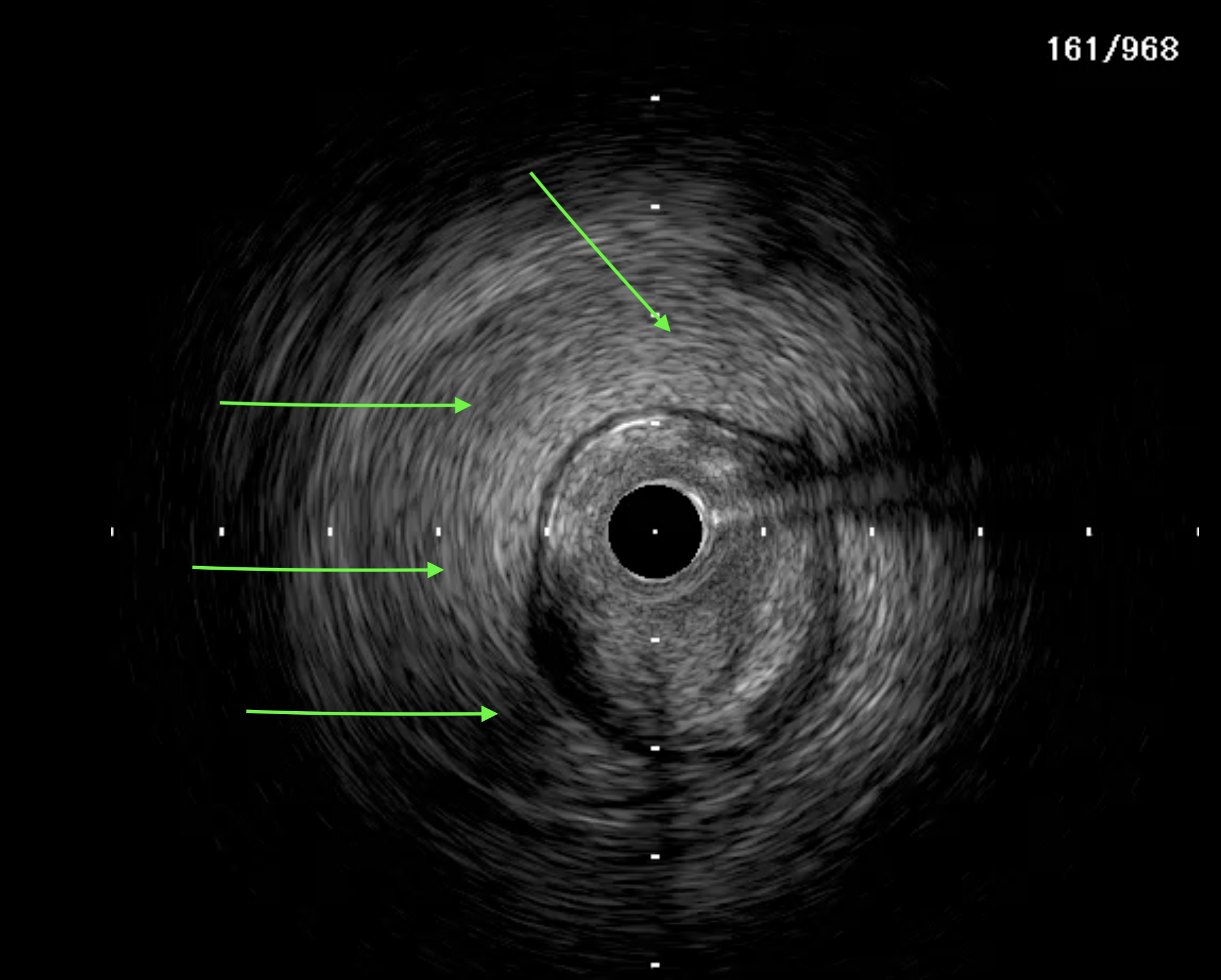 Figure 3. (A) Large extraplaque hematoma.