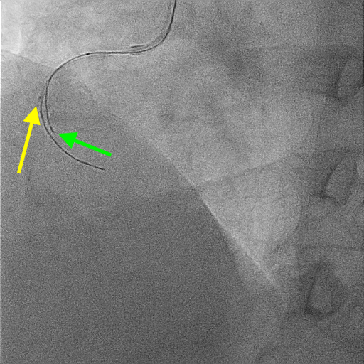 Figure 4. (A) Intravascular ultrasound (