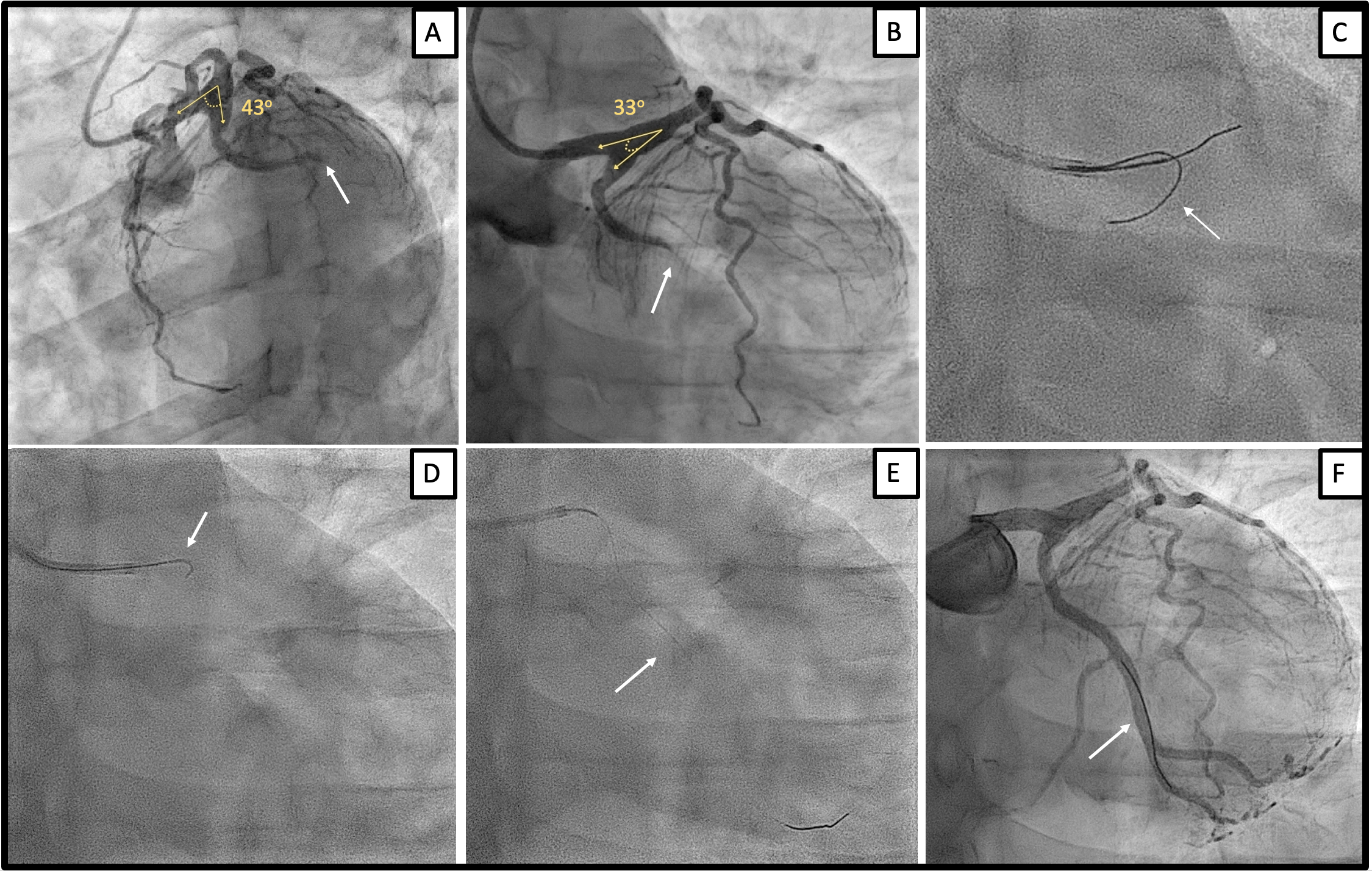 Figure Coronary angiography depicting (A) LCx occlusion 