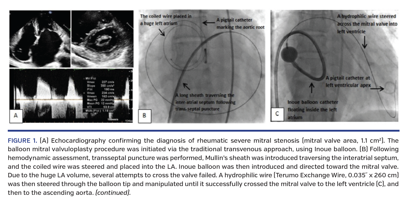 Echocardiography confirming the diagnosis of rheumatic severe mitral stenosis