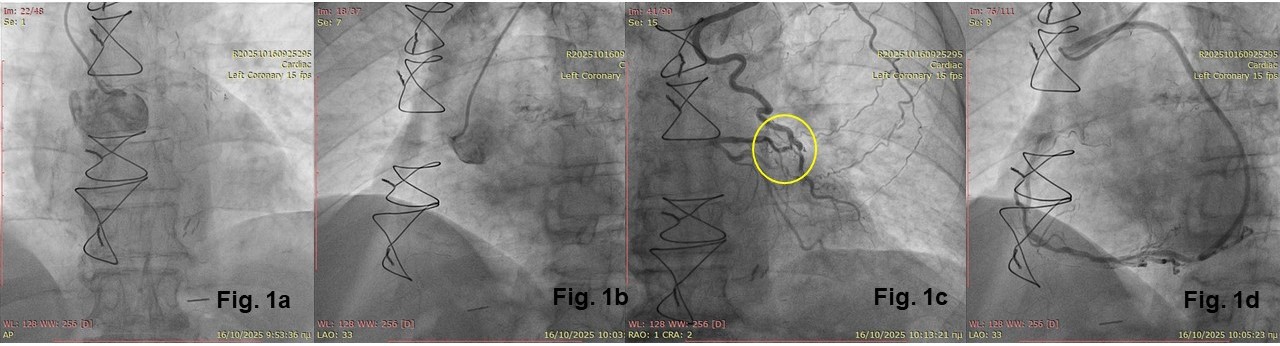 Figure 1. Diagnostic coronary angiography